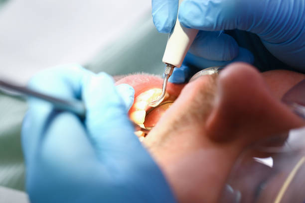 Best Emergency Tooth Extraction in Fontana, CA
